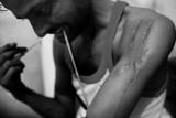 Invisible Scars : Fakir prepares for one of his daily injections. “Since my mother died everything has changed to the worse. If it wasn't for my two small children, I would have committed suicide a long time ago. This damn medicine…”.