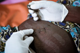 Birth is a dream - Maternity in Africa : A nurse using a razor blade to remove sutures from belly of a woman who had a caesarean